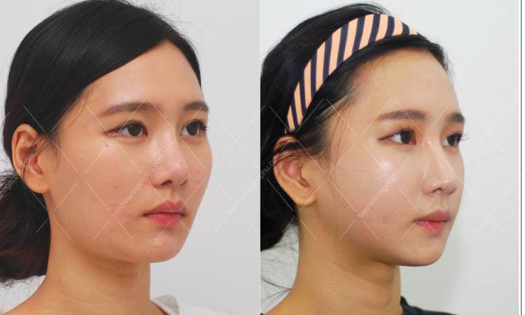 Cheekbone (Zygoma) Reduction