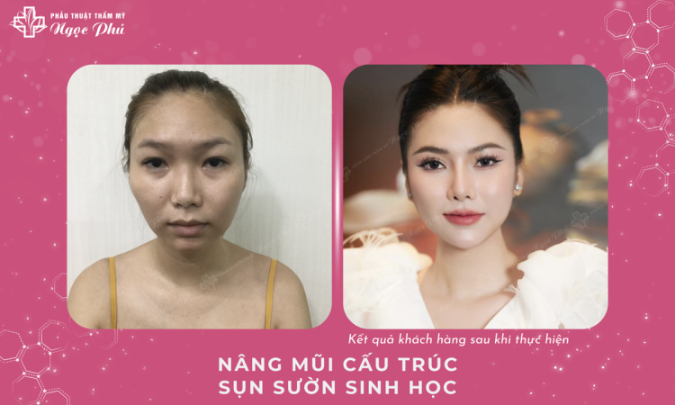 Rib Cartilage Rhinoplasty