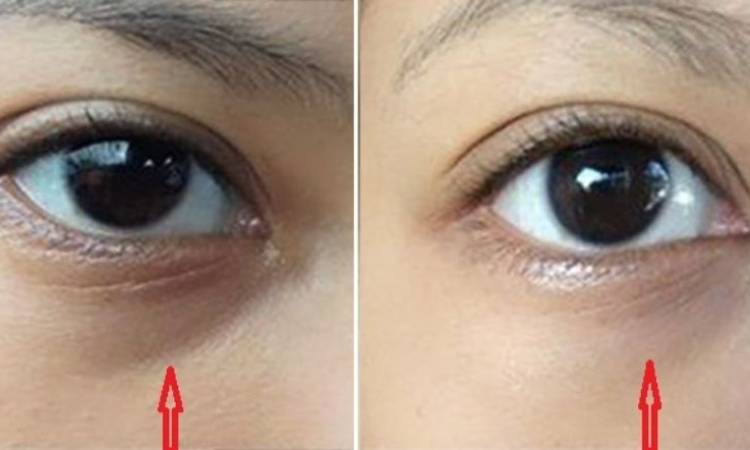 Under-Eye Filler