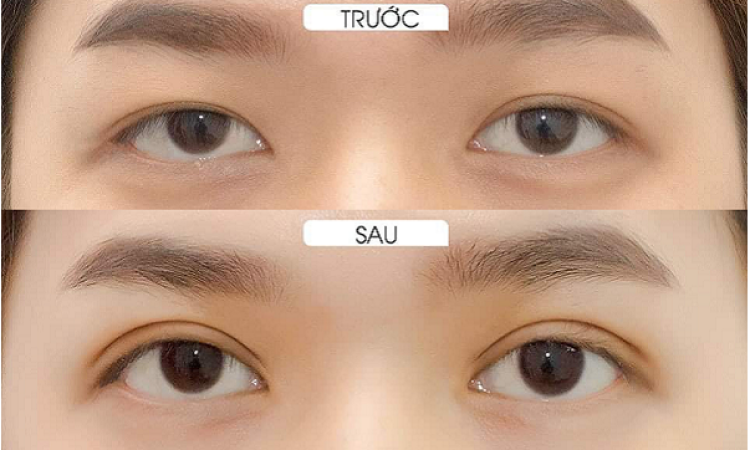 Droopy Ptosis Correction