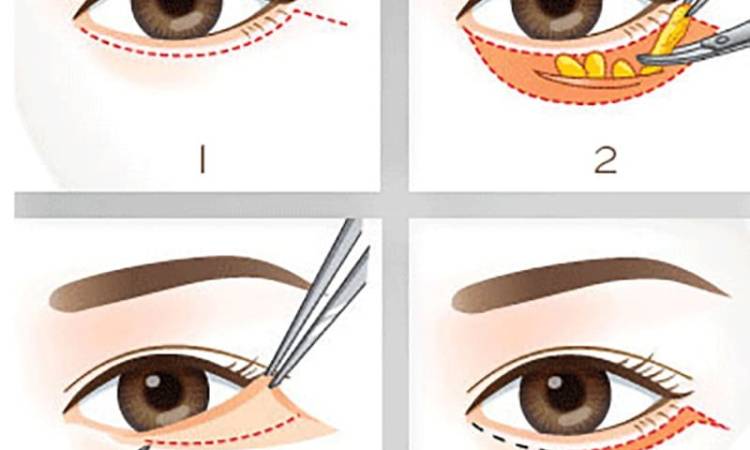 Lower Eyelid Blepharoplasty