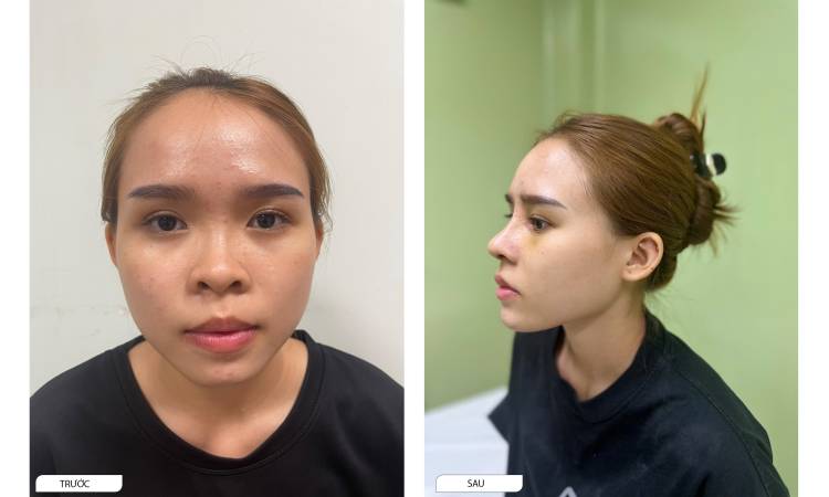 Rib Cartilage Rhinoplasty