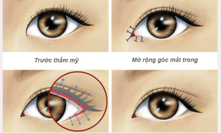 Canthoplasty