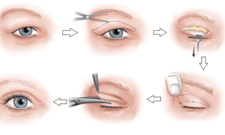 Korean Ptosis Correction