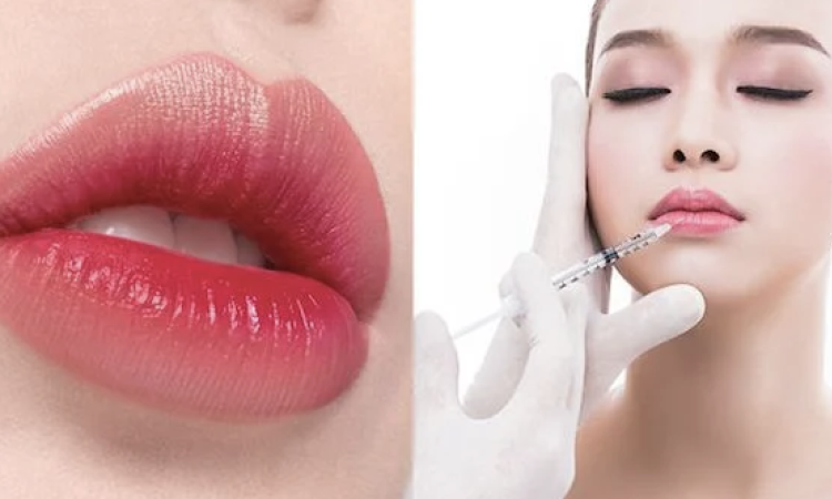 Lip Filler (Non-surgical Lip Augmentation)