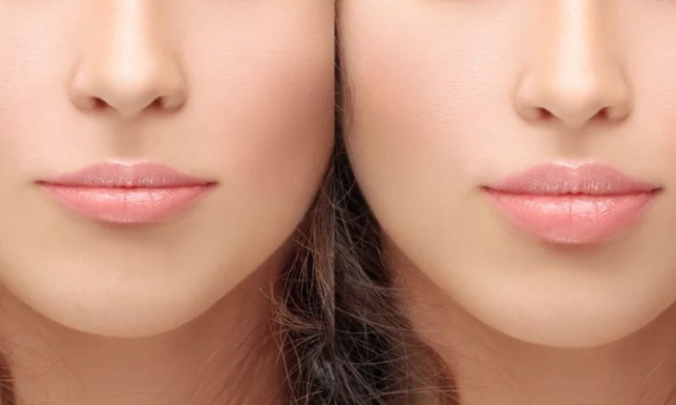 Lip Reduction Surgery