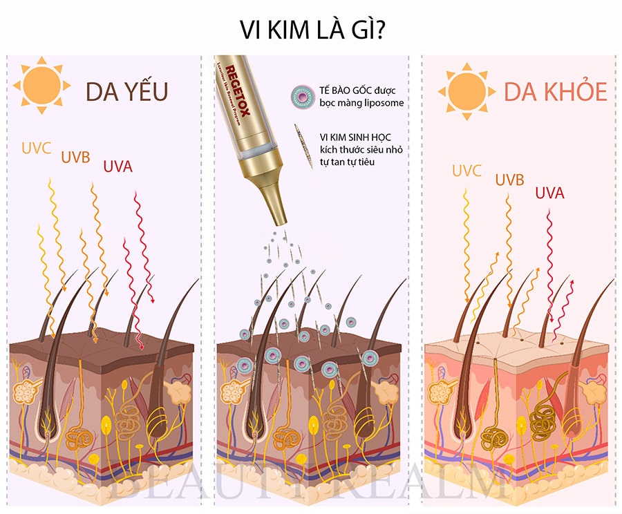 Vi kim tế bào tươi là liệu pháp tăng sinh collagen, khắc phục các khiếm khuyết của da một cách tự nhiên và an toàn