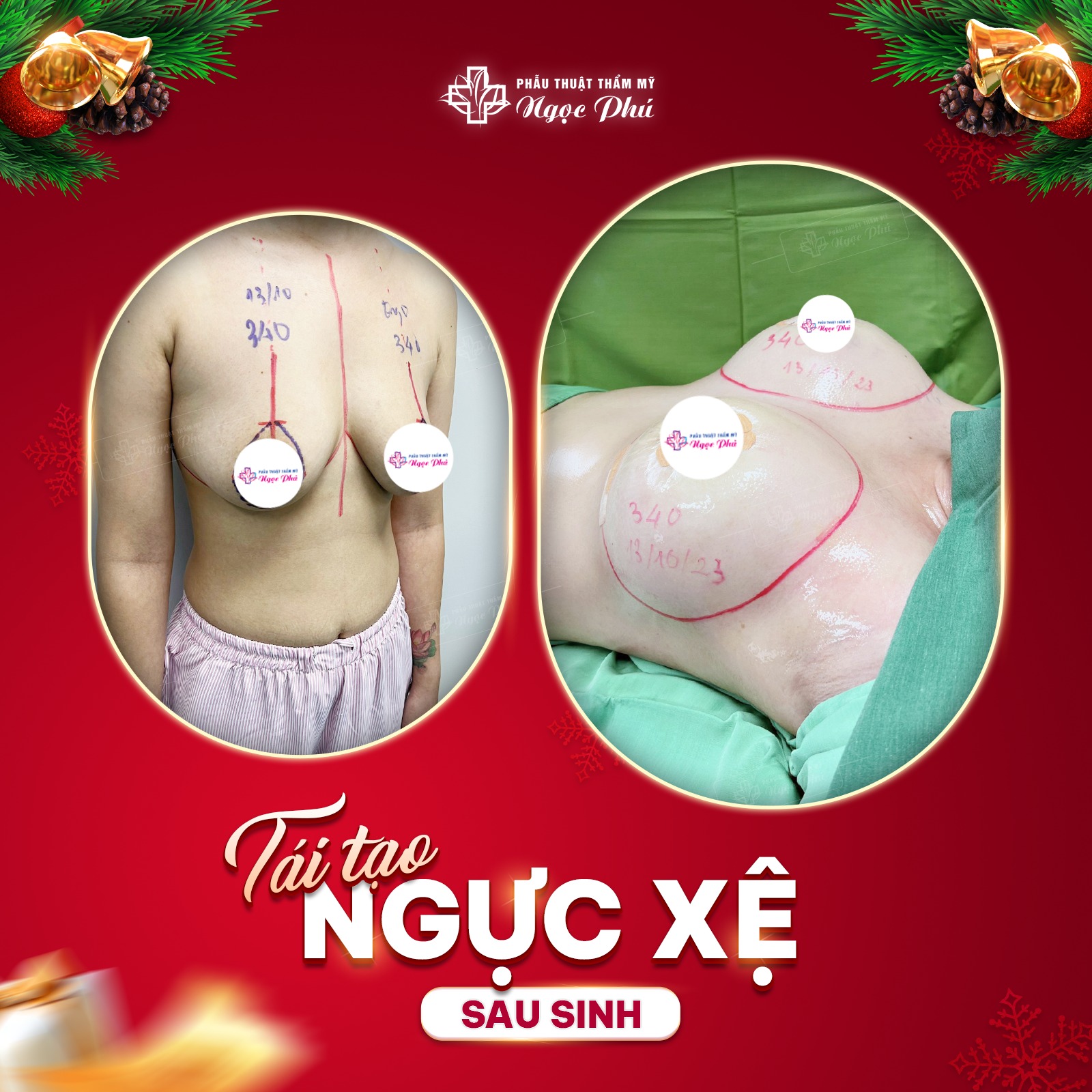 Nâng ngực nội soi tạo khe