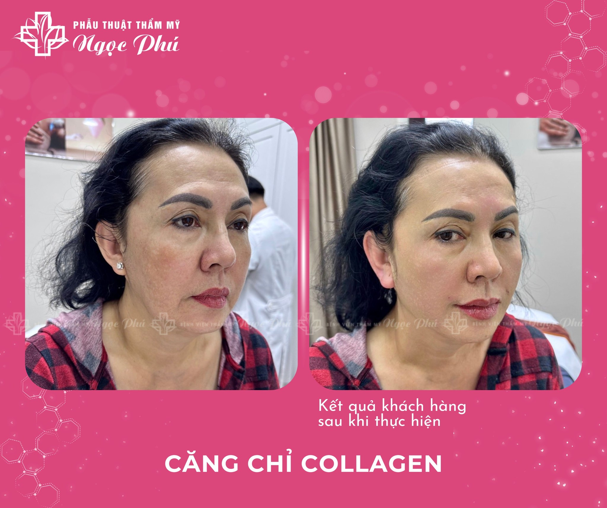 Căng chỉ Collagen được xem là phương pháp trẻ hóa hạn chế xâm lấn, ít thời gian nghỉ dưỡng và được nhiều chị em lựa chọn hiện nay.