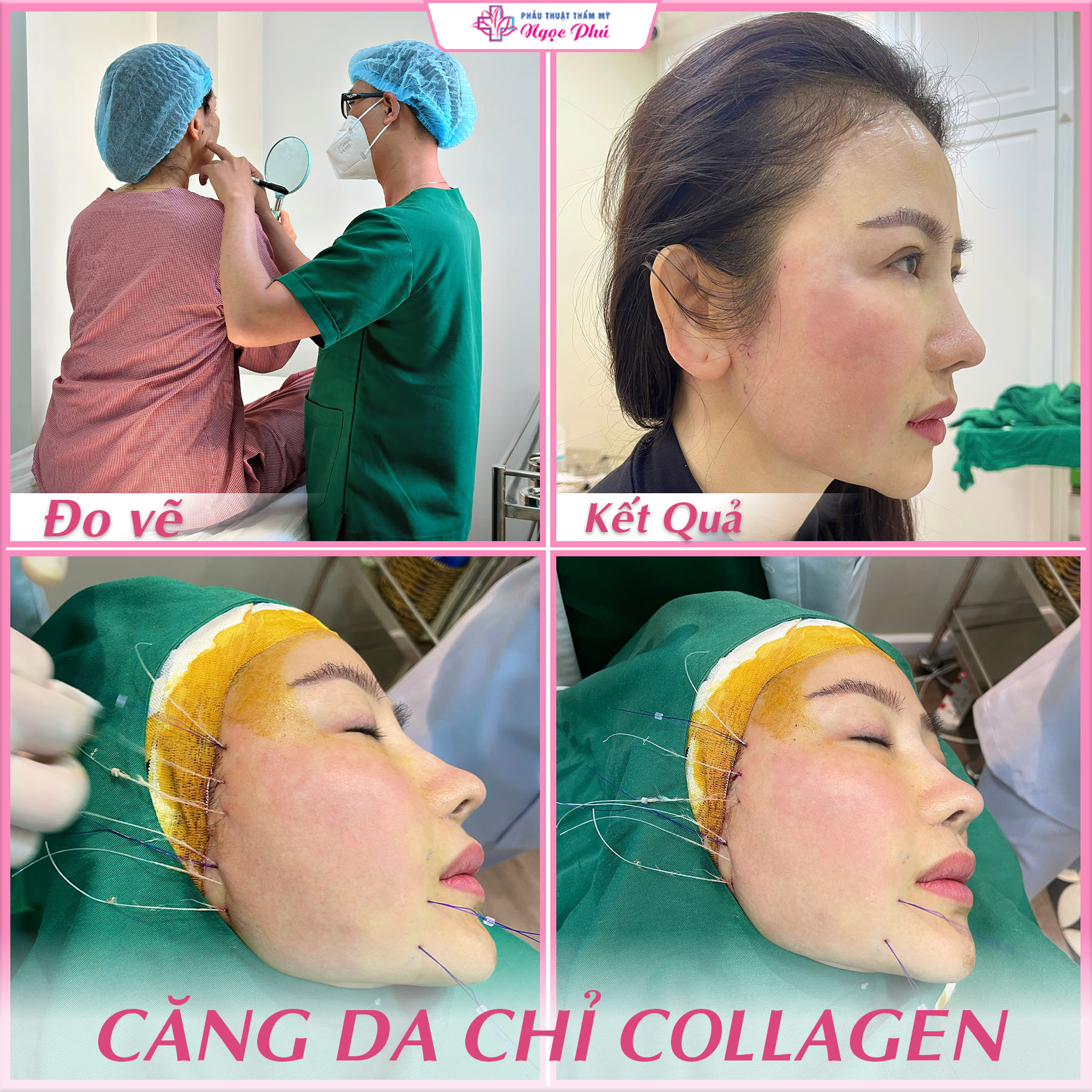 Căng chỉ collagen hay một số nơi vẫn gọi là cấy chỉ hoặc căng chỉ sinh học, căng chỉ nội khoa.