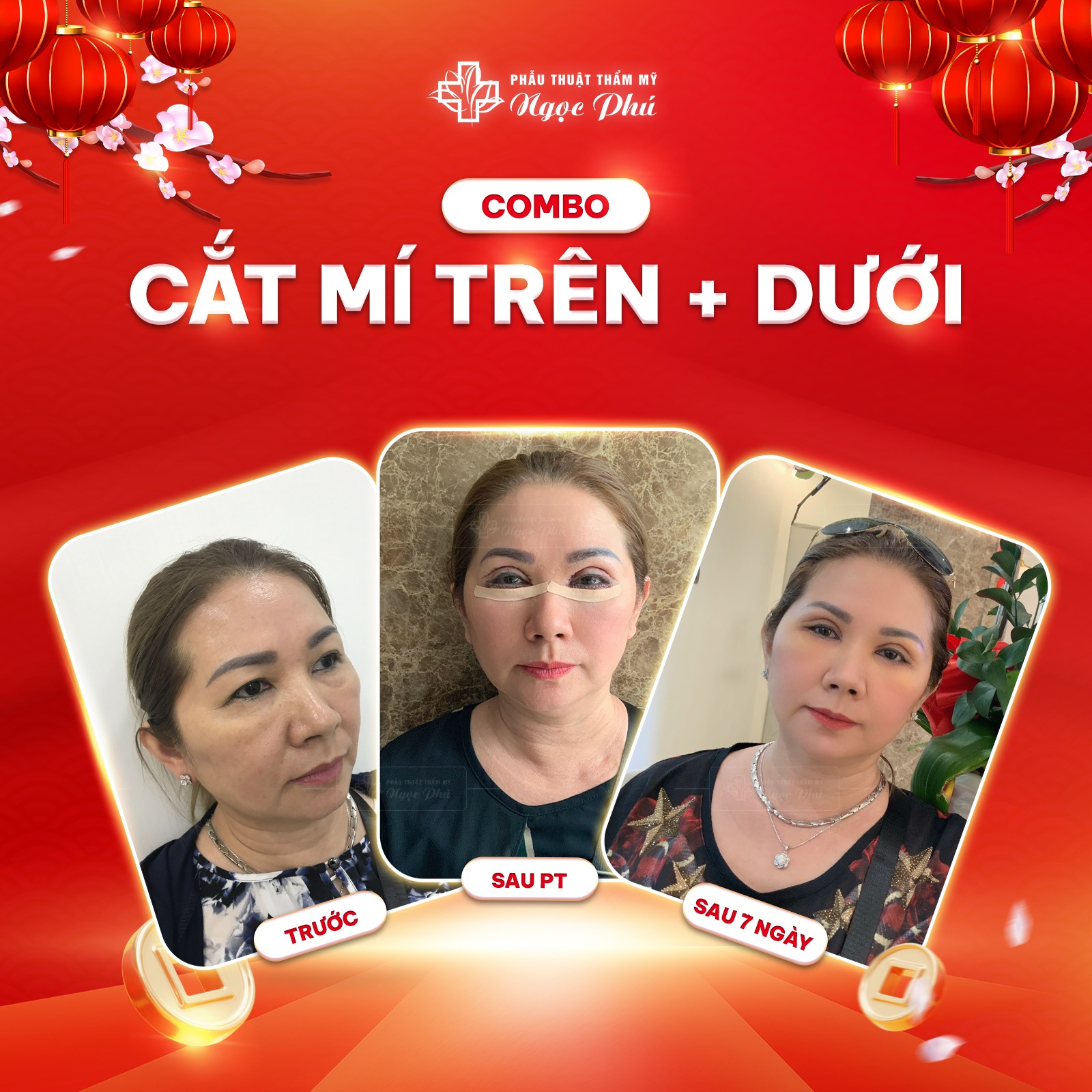 Cắt bọng mắt dưới là phương pháp thẩm mỹ , sử dụng kỹ thuật y khoa tiên tiến để loại bỏ lượng mỡ thừa tích tụ dưới da mí mắt, 