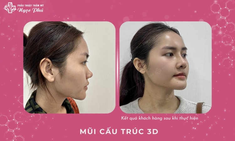 Mặc dù khi có ý định có nên nâng mũi không thường phụ thuộc vào nhu cầu cá nhân và các yếu tố khác, nhưng cũng cần nghe lời khuyên của bác sĩ để đảm bảo an toàn cho sức khỏe.