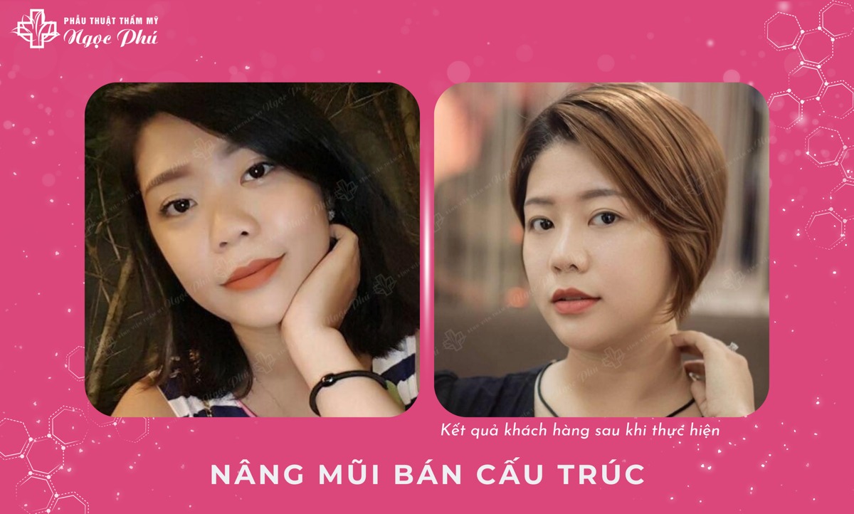 Nâng mũi bán cấu trúc