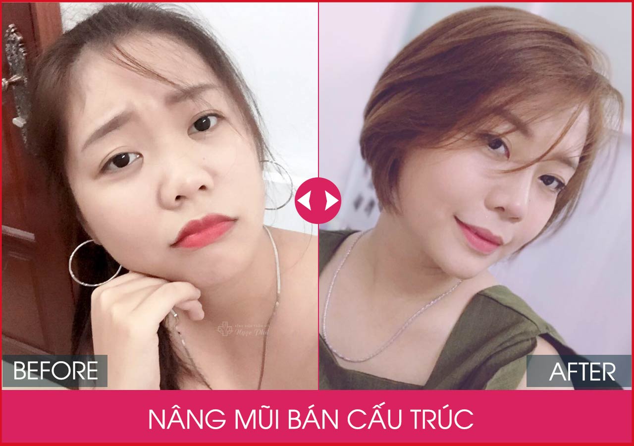 Phương pháp nâng mũi bán cấu trúc có bền lâu không?