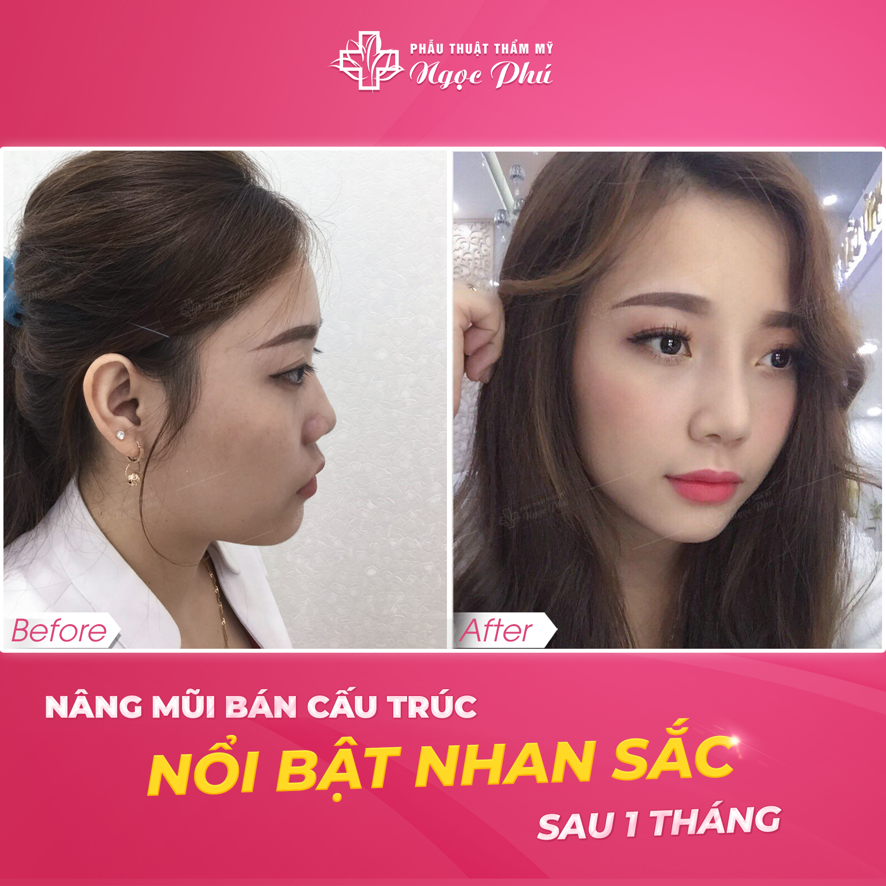 Nâng Mũi Bán Cấu Trúc Soft Line