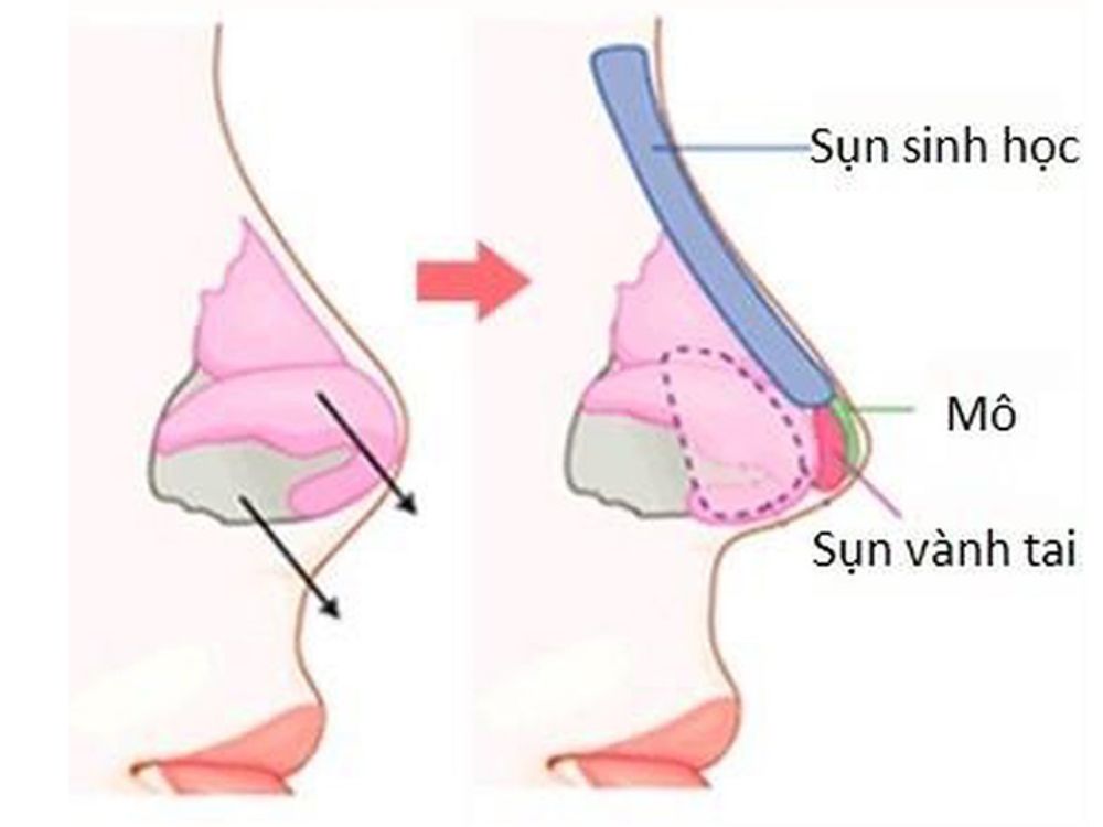 Nâng mũi bán cấu trúc là phương pháp nâng mũi ít tác động vào cấu trúc mũi, các bác sĩ sẽ tập trung điều chỉnh một phần của vùng mũi để tạo ra dáng mũi cân đối và hài hoà với khuôn mặt.