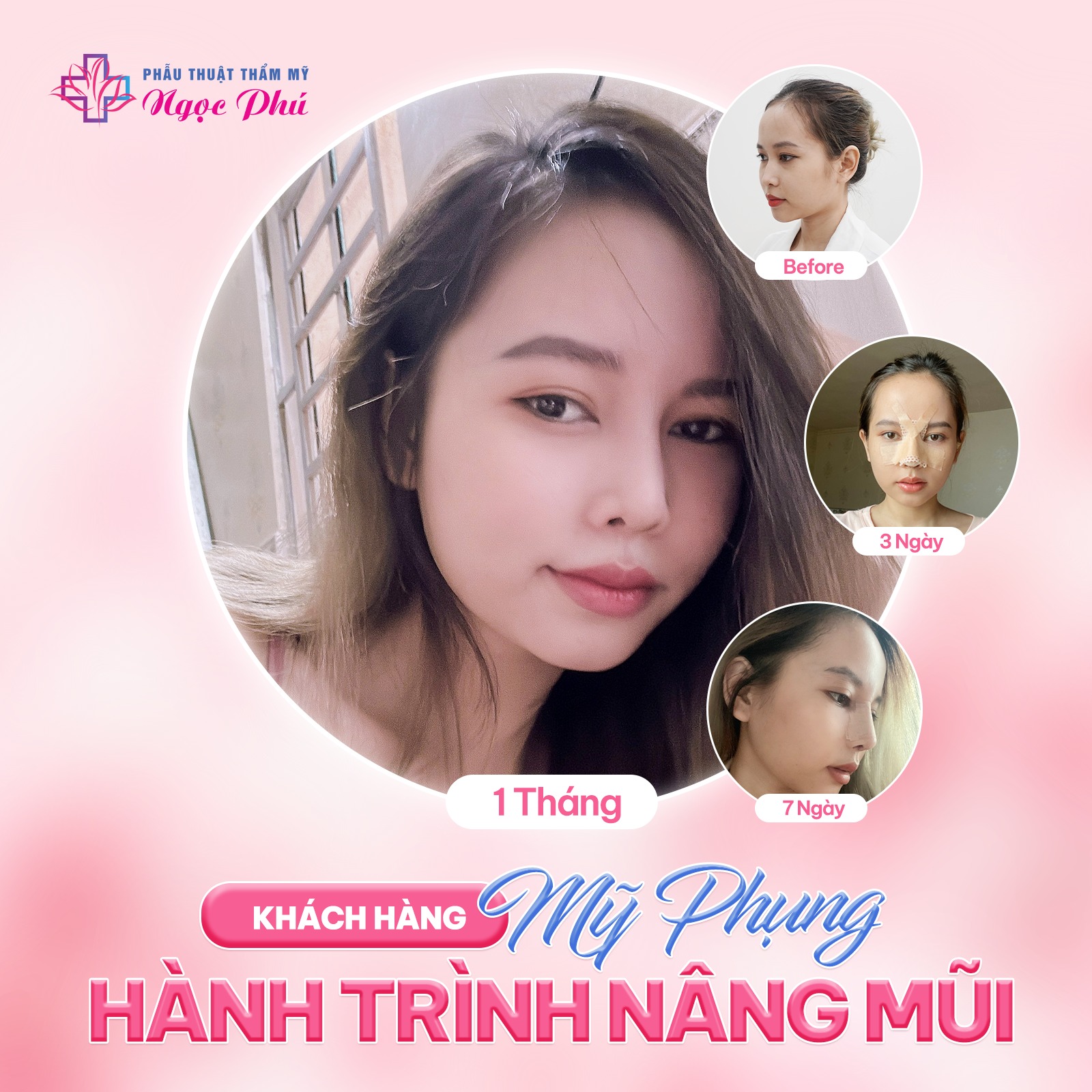 Nâng mũi bọc sụn giúp bạn có dáng mũi tự nhiên mà không lo lộ đầu sống mũi, trả lại dáng mũi mềm mại tự nhiên như mũi thật.