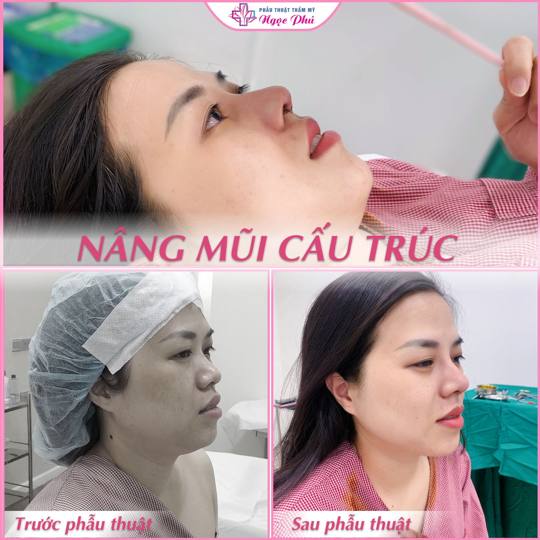 Nâng mũi gom lại không đồng nghĩa với việc sống mũi thấp đi. 