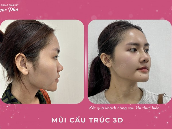 Kỹ thuật nâng mũi thường kết hợp với việc sửa cấu trúc mũi, bao gồm sụn sống mũi và sụn đầu mũi. 