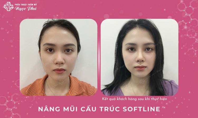 Để mũi vào form ổn định sau khi phẫu thuật hoặc điều chỉnh, bạn cần tuân thủ một số nguyên tắc chăm sóc cẩn thận và hợp lý