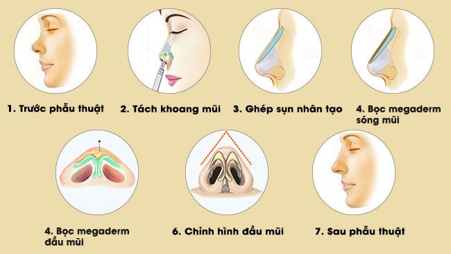 Chất liệu độn megaderm có vai trò quan trọng trong phương pháp nâng mũi, nó được xem như một tấm nệm, được đặt giữa sụn nhân tạo và lớp da mũi thật, có nhiệm vụ chính bảo vệ đầu mũi khỏi sự cọ xát và ăn mòn từ sụn nhân tạo đối với da đầu mũi.