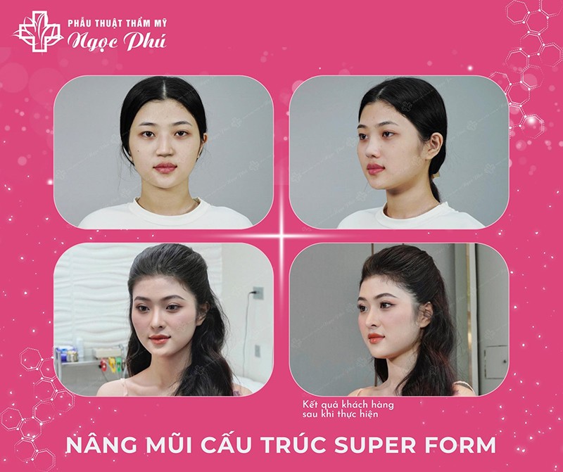 Thẩm mỹ Thẩm Mỹ Việt Nam đa dạng các phương pháp nâng mũi