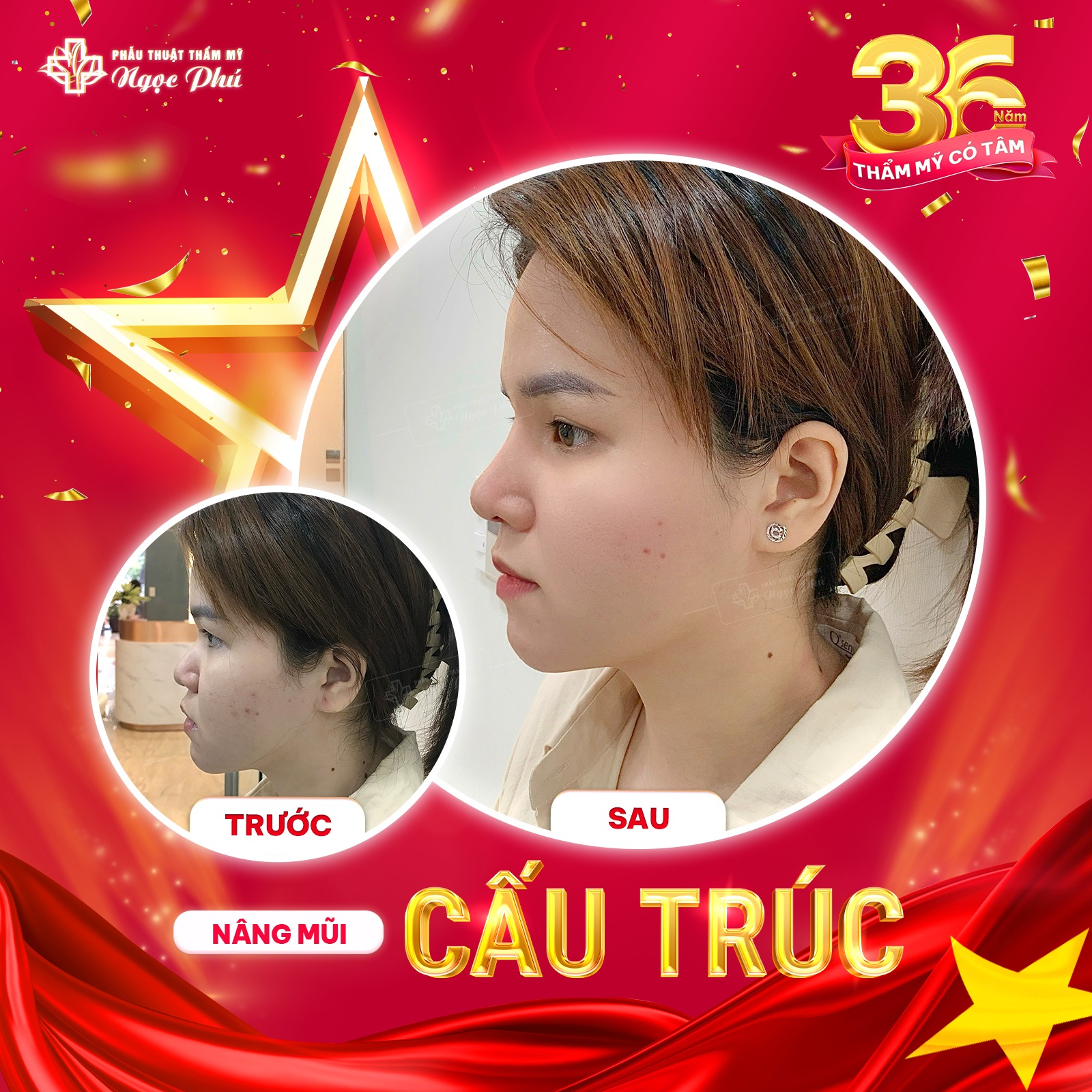 Mũi đẹp tự nhiên cần hài hòa với tổng thể các đường nét trên khuôn mặt, tạo nên sự cân đối, thanh tú.