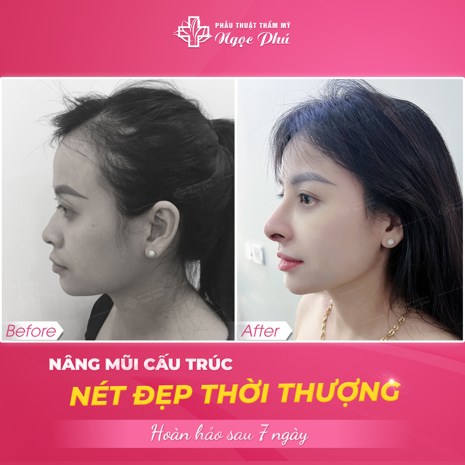 Nâng sống mũi tự nhiên cần có sống mũi cao, thẳng và thon gọn, hài hòa với các đường nét khác trên khuôn mặt.