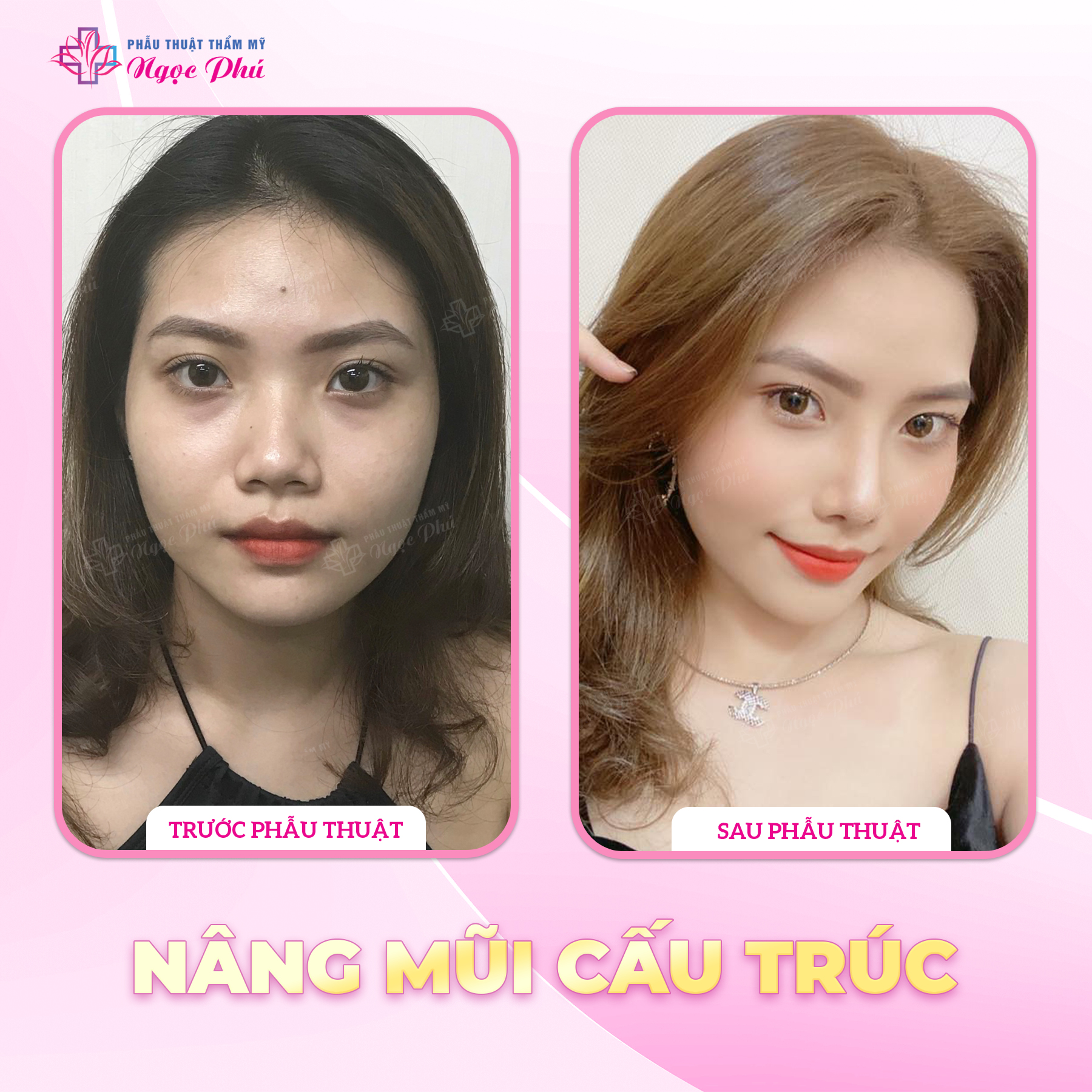 Nâng mũi cấu trúc: Sử dụng sụn tự thân (sụn vách ngăn, sụn vành tai) hoặc sụn nhân tạo để tạo hình sống mũi, đầu mũi, cánh mũi.