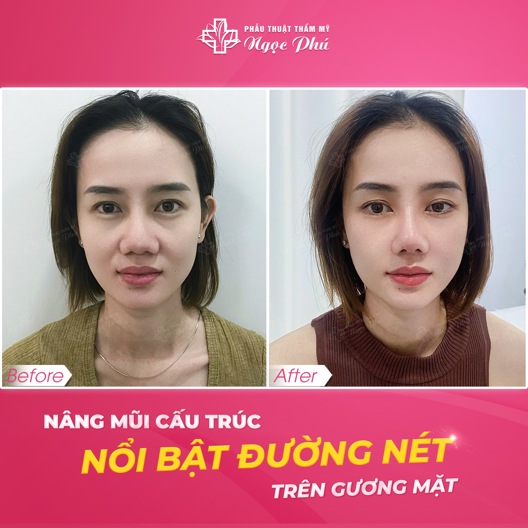 Nâng mũi sụn sườn và những sự thật xoay quanh khiến nhiều khách hàng lầm tưởng, chính là chủ đề mà bài viết muốn đề cập đến bạn đọc