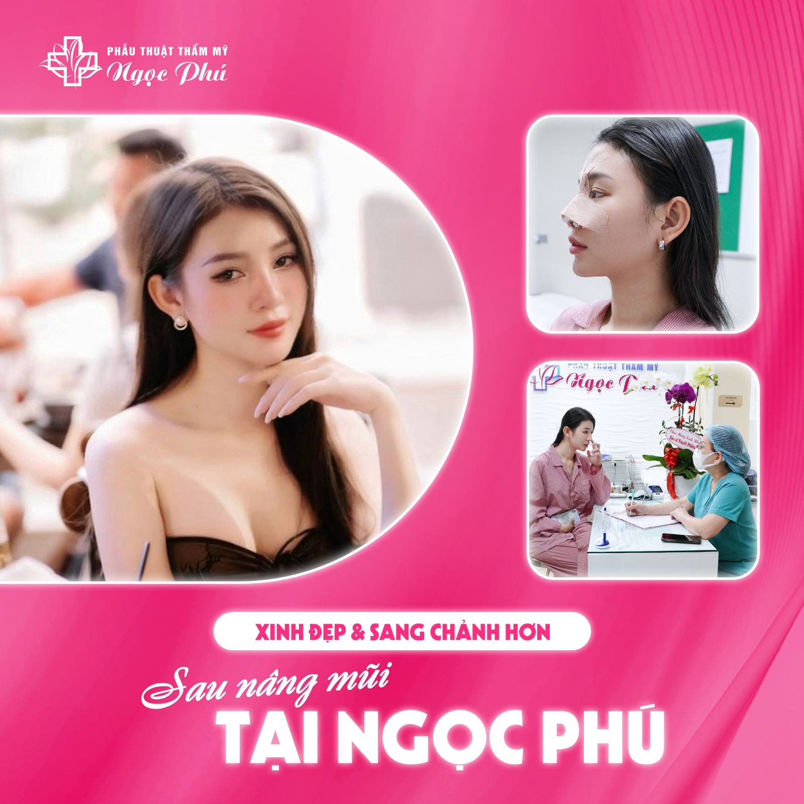 Nâng mũi sụn tai là phương pháp thẩm mỹ sử dụng sụn tự thân từ vành tai để cải thiện cấu trúc và hình dáng mũi.