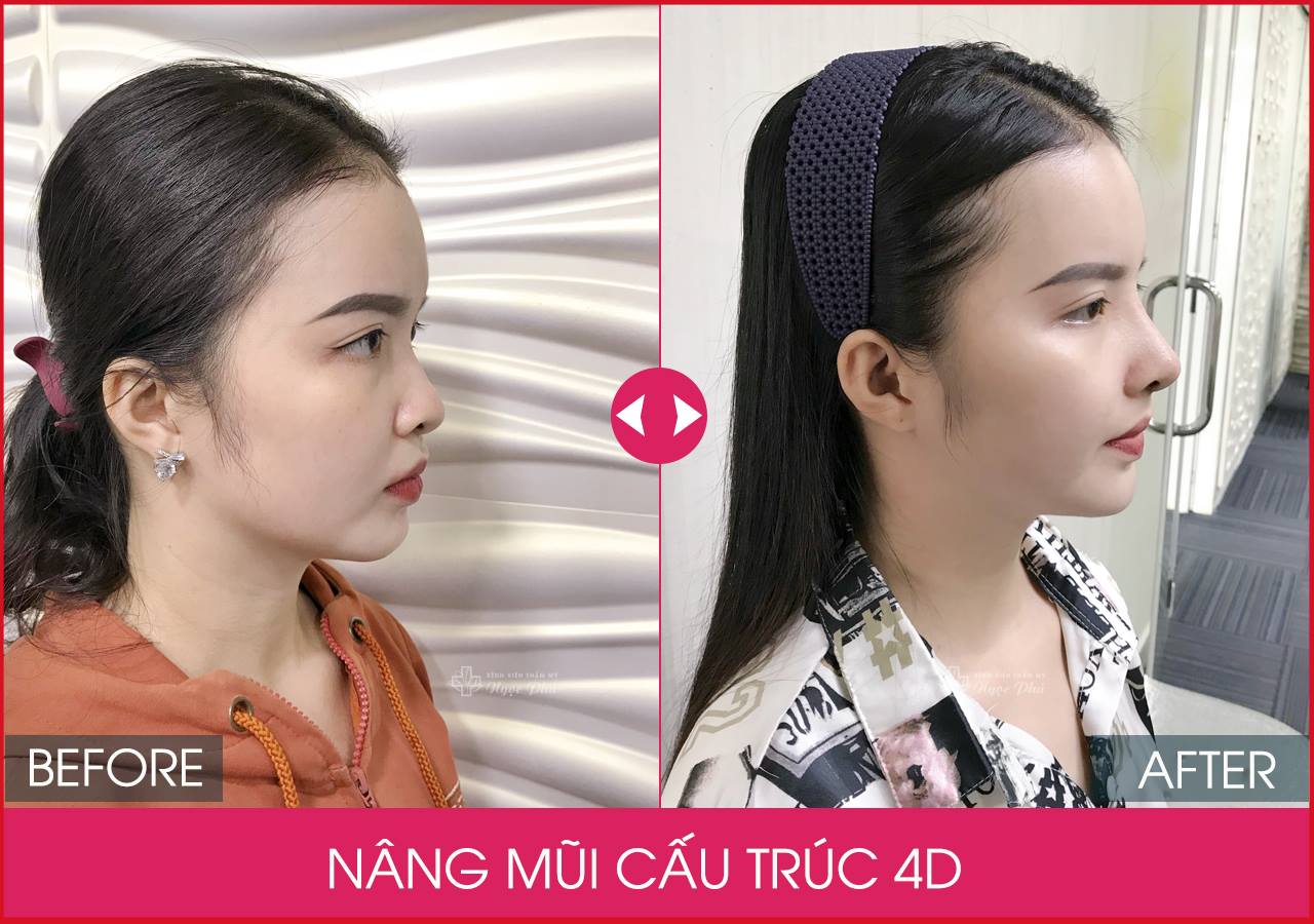 Nâng mũi tự nhiên giá bao nhiêu là câu hỏi thường gặp khi mọi người đang có ý định nâng mũi, vì giá thành quyết định đến việc khả năng chi trả của khách hàng. 