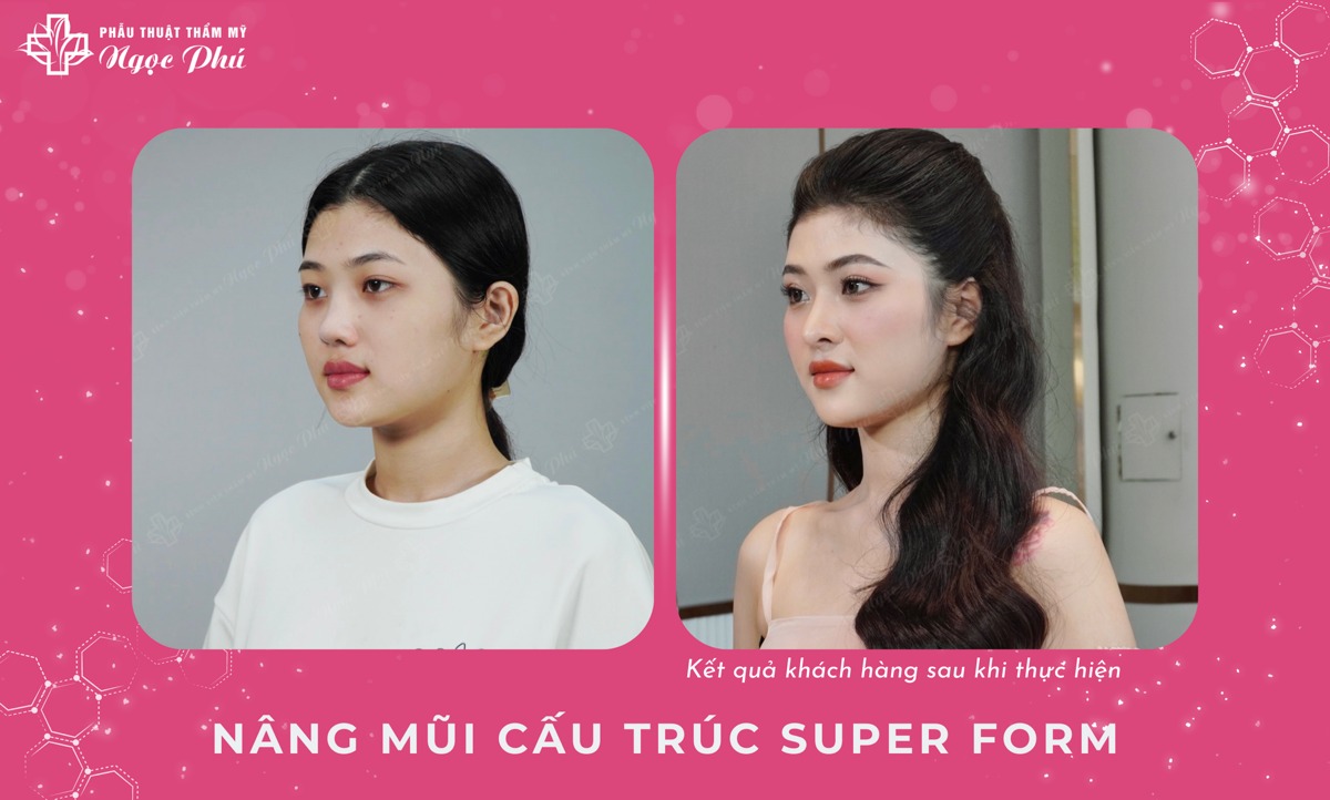 Chất liệu sụn mũi được sử dụng