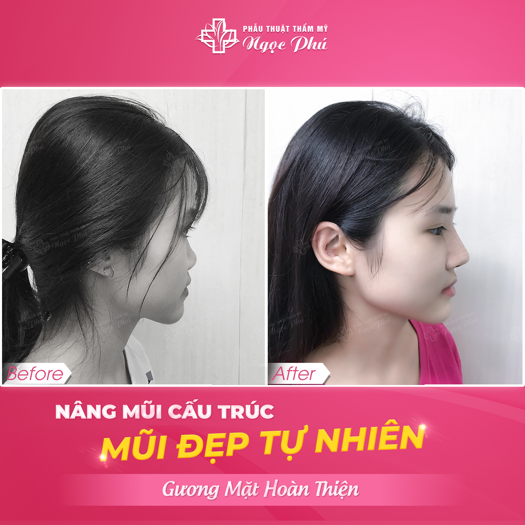 Việc lựa chọn giữa nâng mũi cấu trúc và bán cấu trúc phụ thuộc rất nhiều vào đặc điểm mũi của từng cá nhân và kết quả mong muốn.