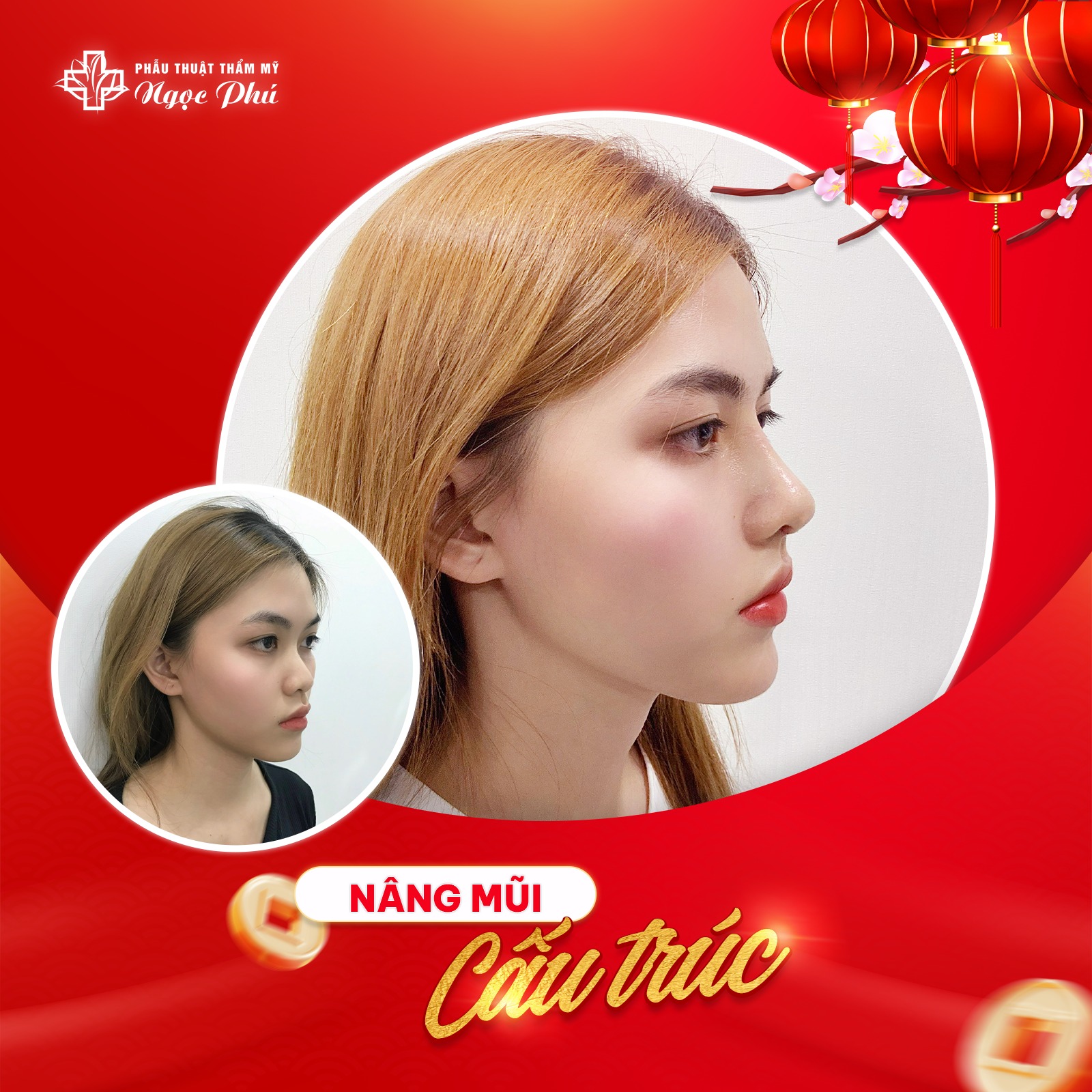 Ngọc Phú là một trong số ít cơ sở thẩm mỹ tiên phong ứng dụng các công nghệ nâng mũi hiện đại nhất từ Hàn Quốc như: nâng mũi S Line, nâng mũi Soft Line, nâng mũi Hàn Quốc,...