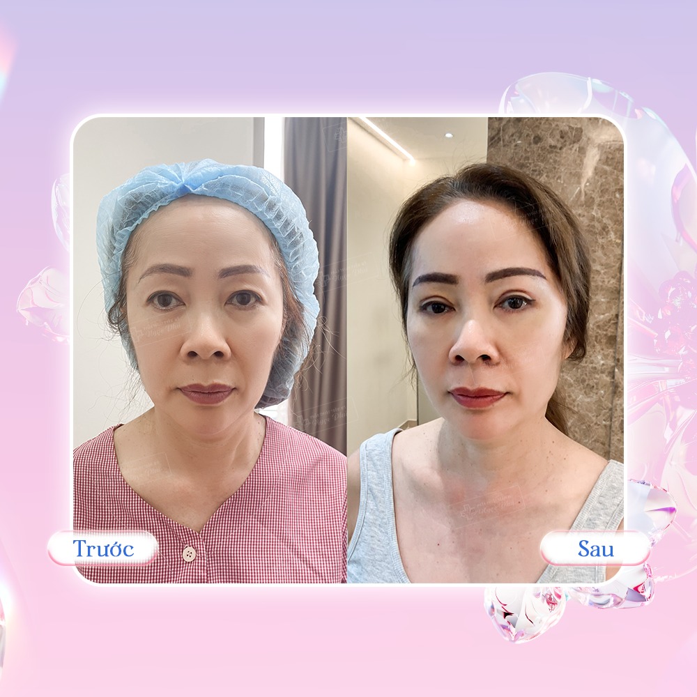  Căng da mặt bằng chỉ Collagen (Thread lift)