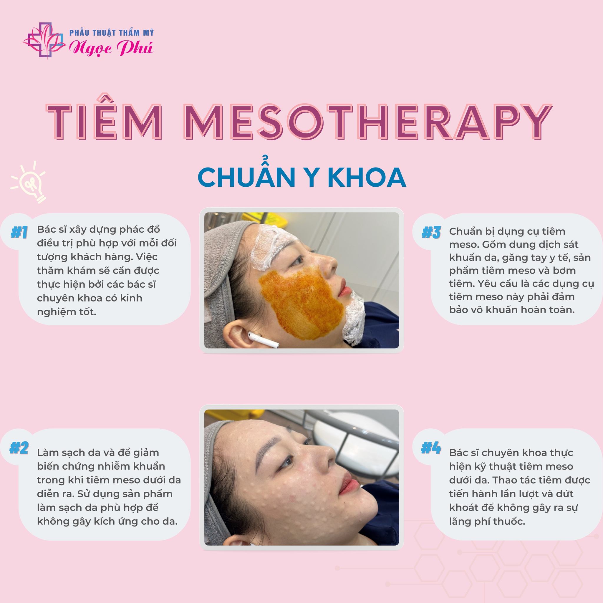 Tiêm Meso có tốt không - Quy trình tiêm Meso tại Thẩm mỹ Thẩm Mỹ Việt Nam