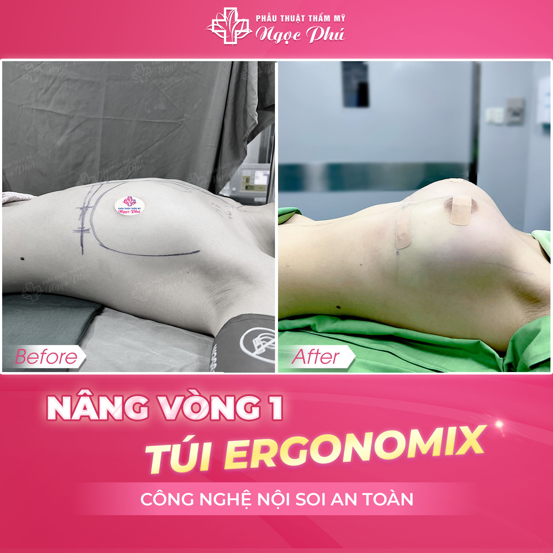 Tại Thẩm mỹ Thẩm Mỹ Việt Nam, chúng tôi cam kết mang đến dịch vụ nâng ngực an toàn không ảnh hưởng đến thiên chức làm mẹ của người phụ nữ. 