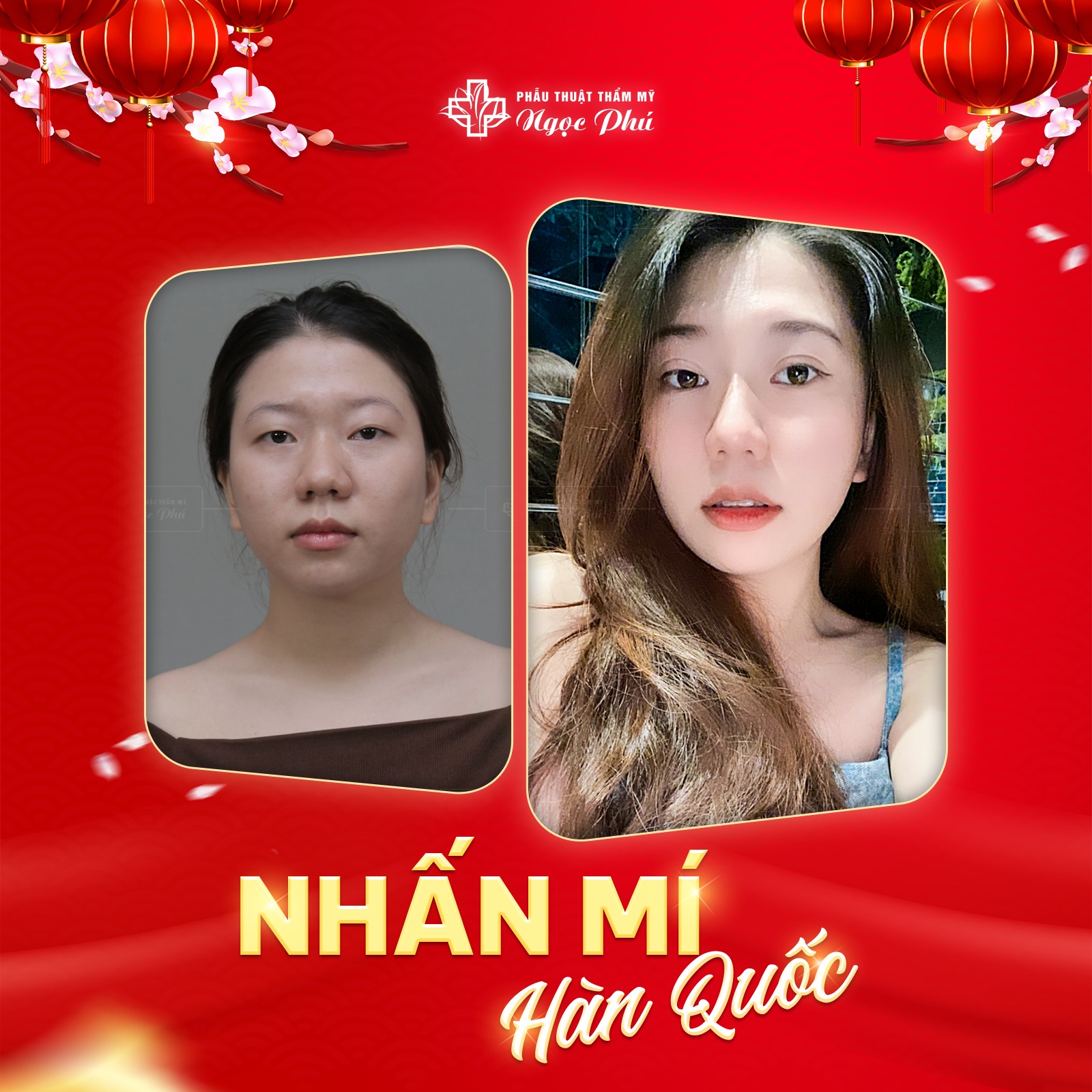 Nhấn mí Hàn Quốc