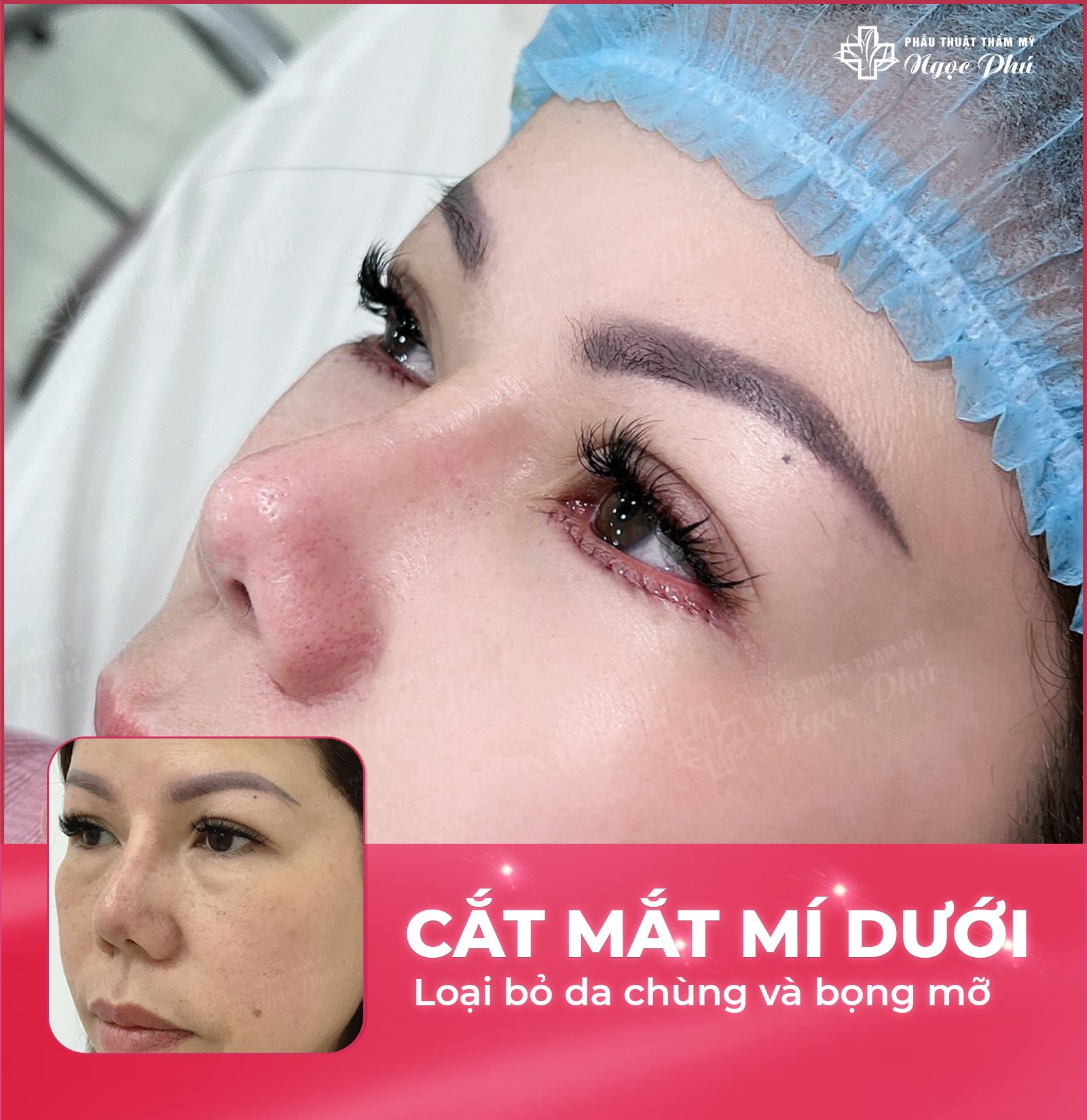 Cắt mí dưới