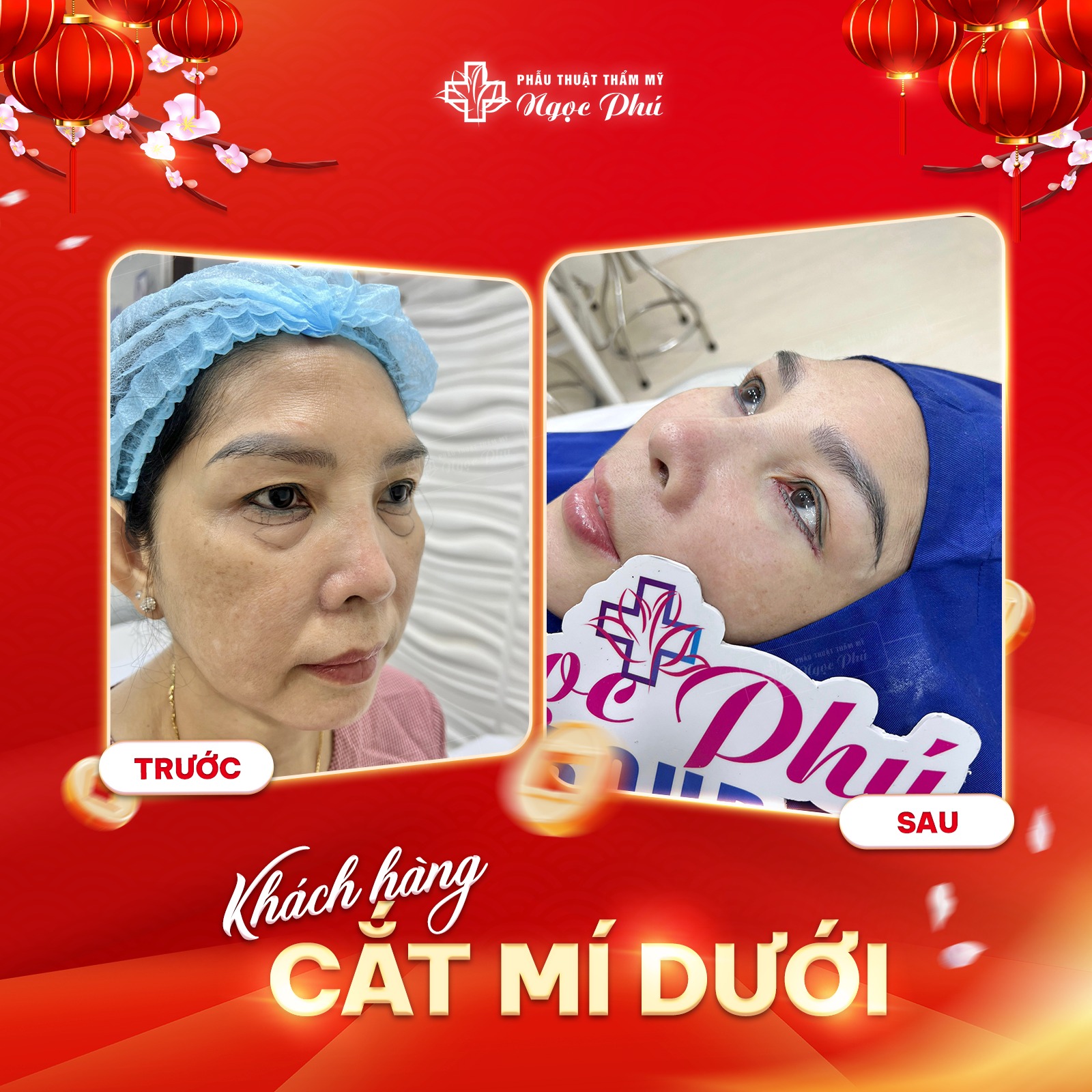 Cắt mí dưới