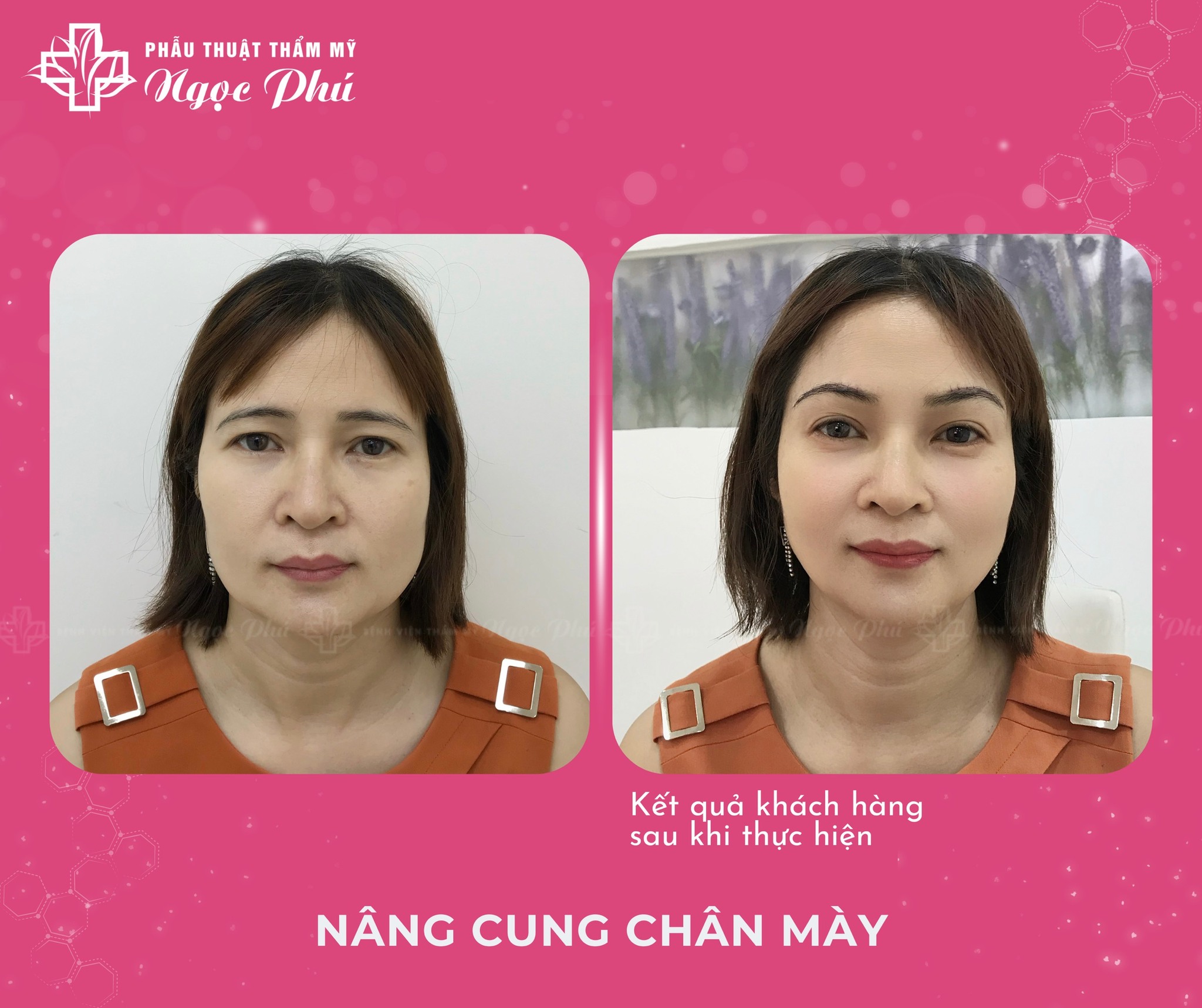 Nâng cung mày