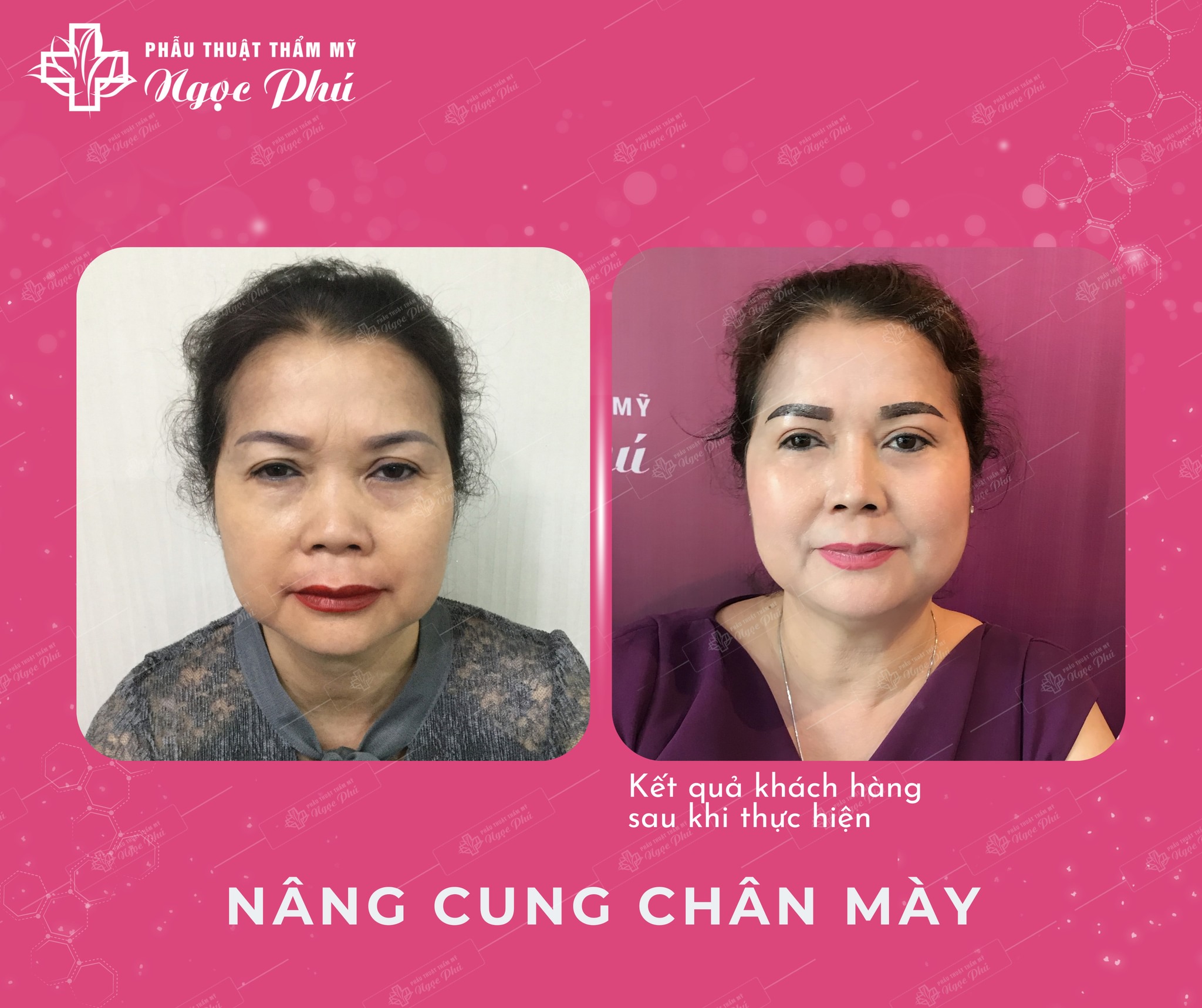  Nâng cung mày