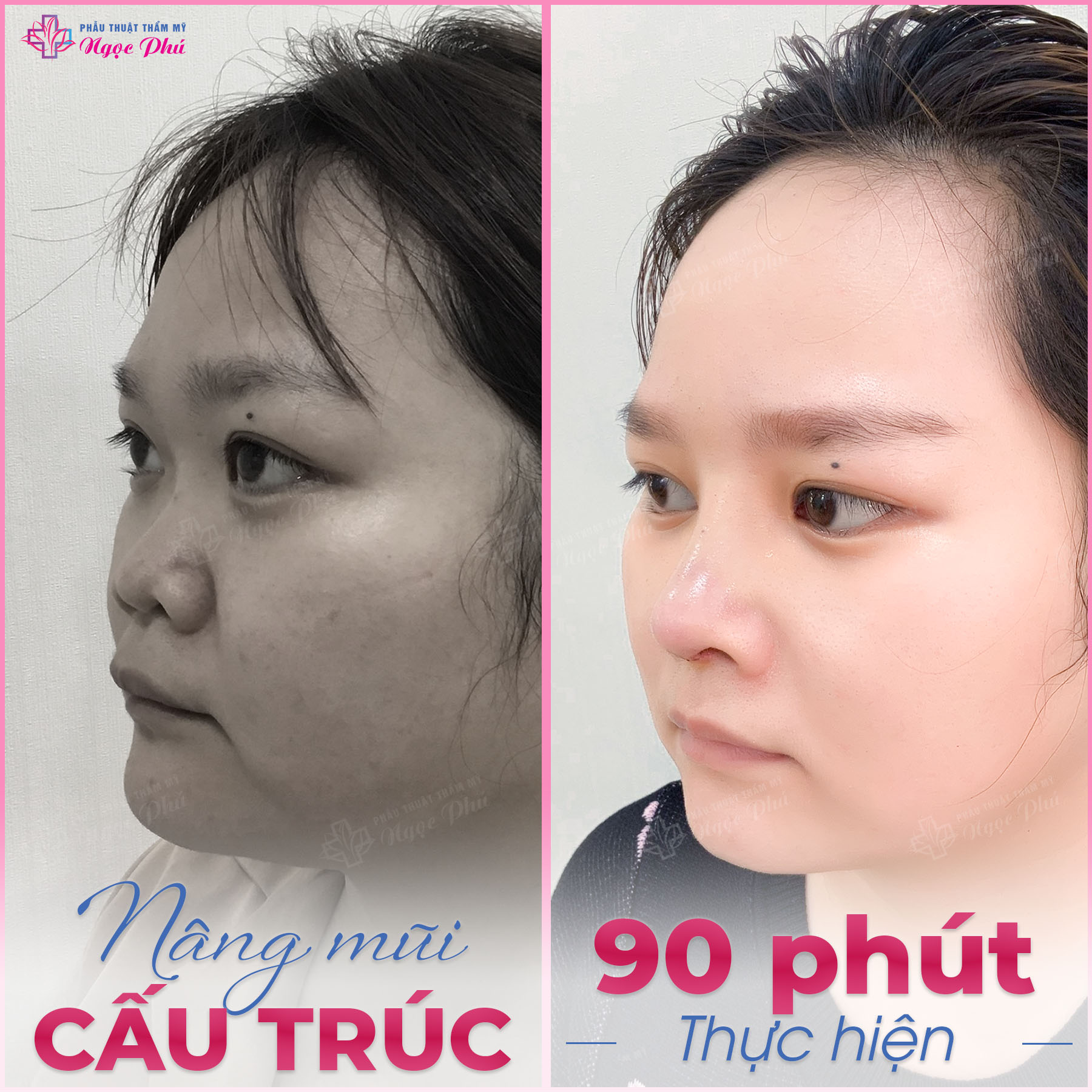 Trước và sau nâng mũi Softline